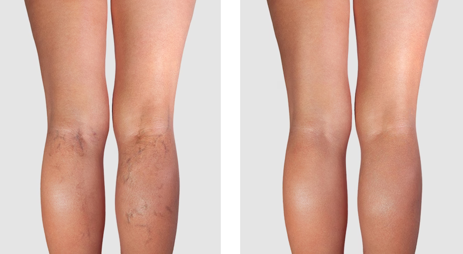 Woman's legs before and after endovenous laser therapy with ultrasound monitoring by Medapp Technology.